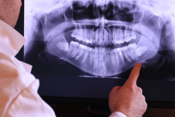 Best Emergency Treatment for Dental Infections or Abscesses in Sky Valley, CA